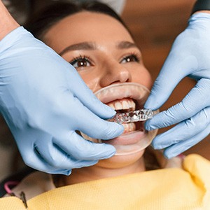 Orthodontist placing clear aligner on patient
