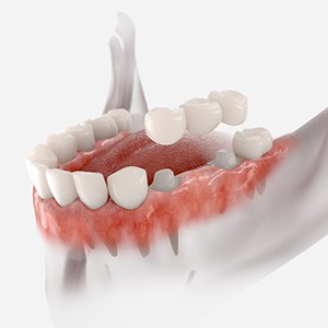 Illustration of an implant bridge