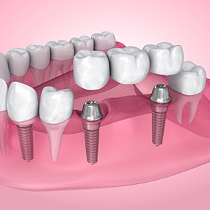 Illustration of an implant bridge