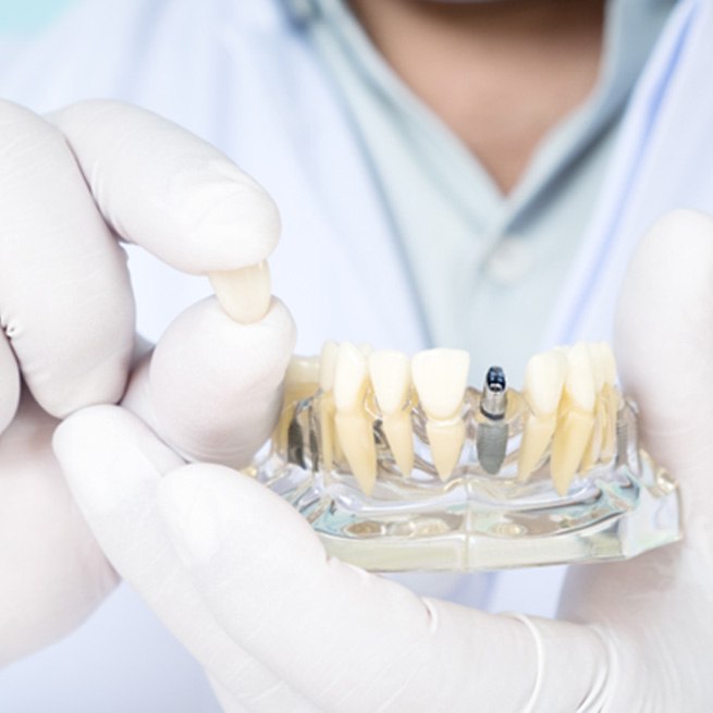 Dentist wearing white holding sample implant and crown 