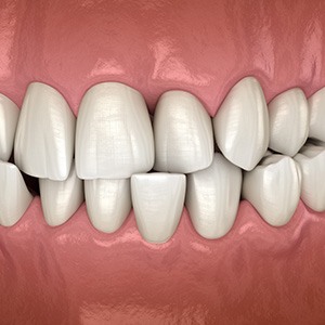 Illustration of a crossbite