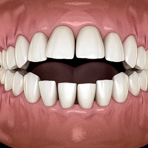 Illustration of an open bite