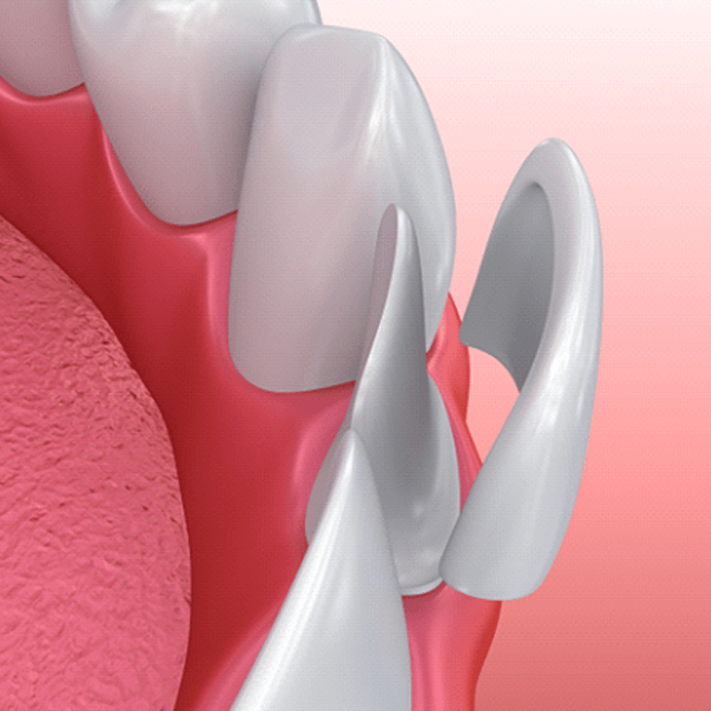 Illustration of veneer being applied to a tooth