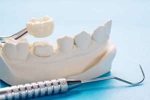Dental crown held by tweezers above model teeth